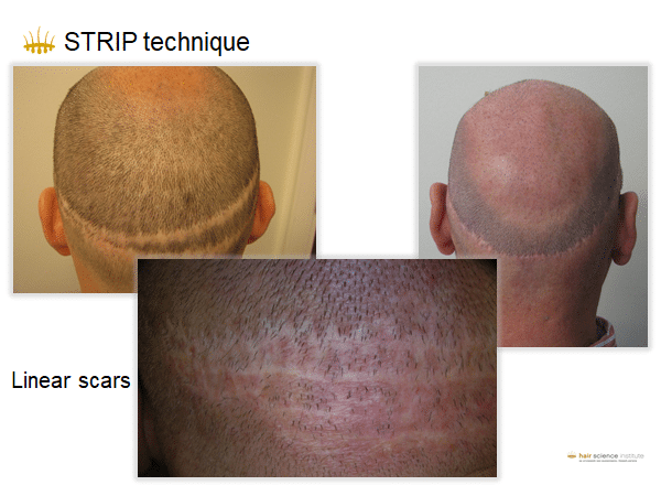 strip technique hair transplant man