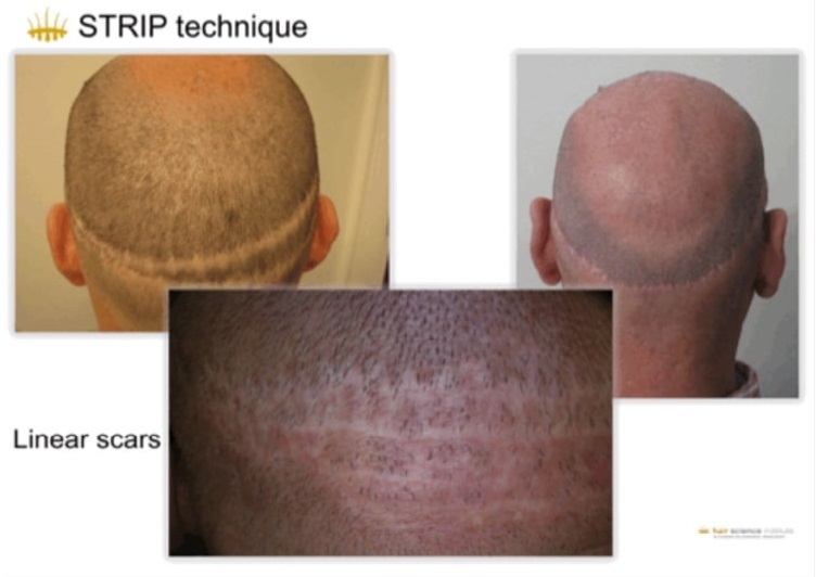 Trapianto per Alopecia: Rigenerazione Follicolare – Hasci Italia