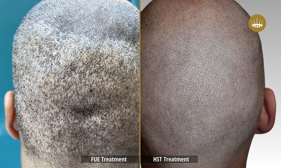 Risks of FUE Hair Transplants and Androgenetic Alopecia – Hasci Italia